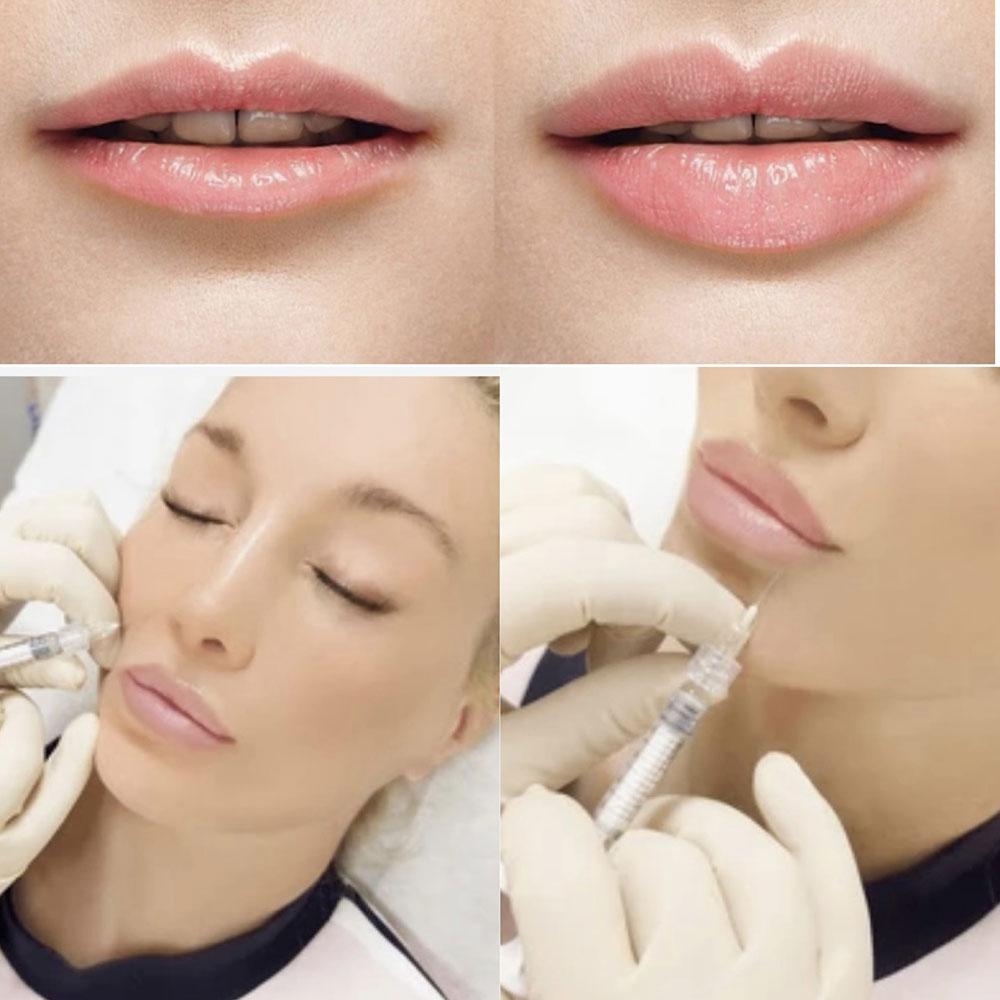 Foundation Dermal Filler Course - The Art Of Aesthetics, Beauty ...